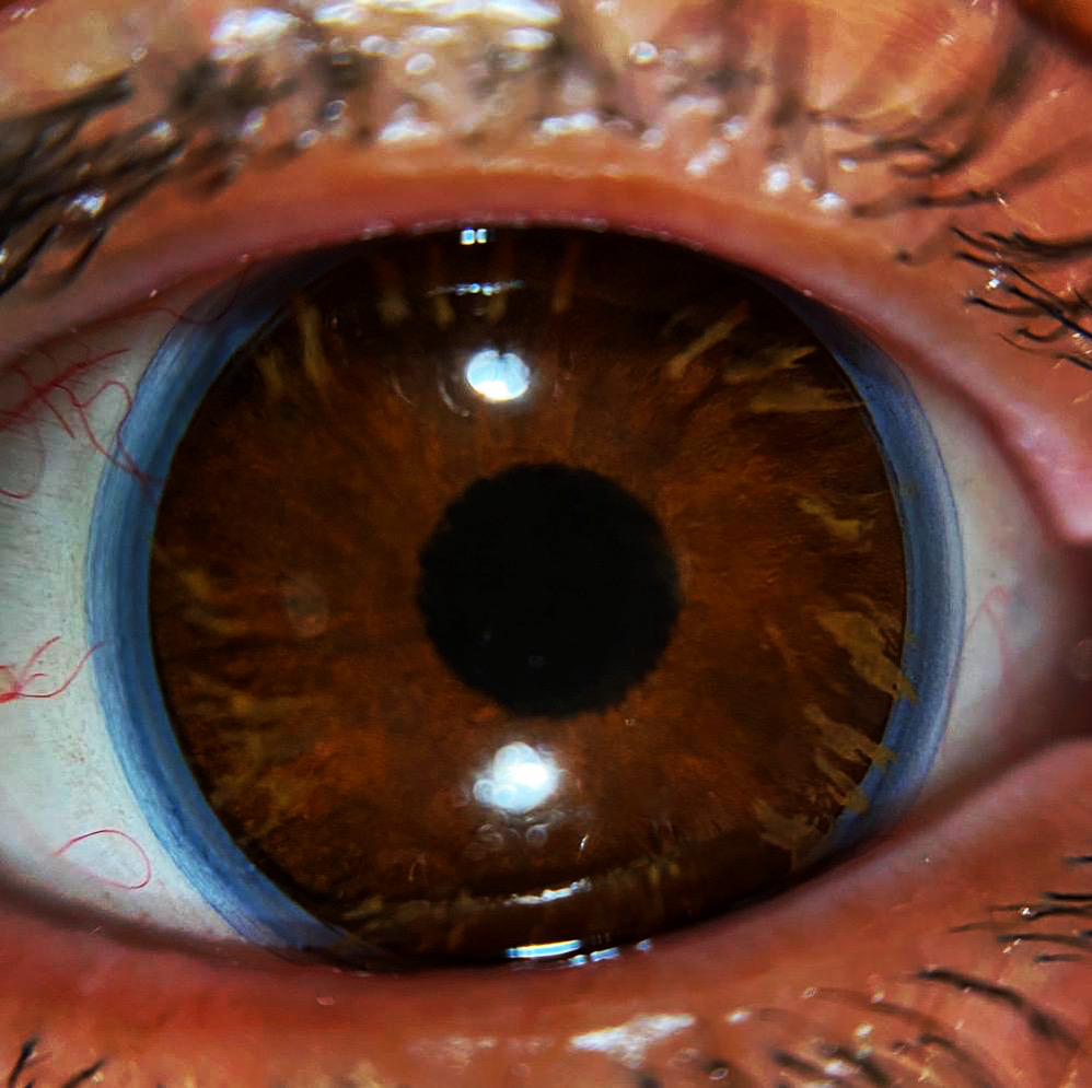Meyella Grænseværdi Problem Smartphone Eye Imaging Adapter - Products - VisuScience